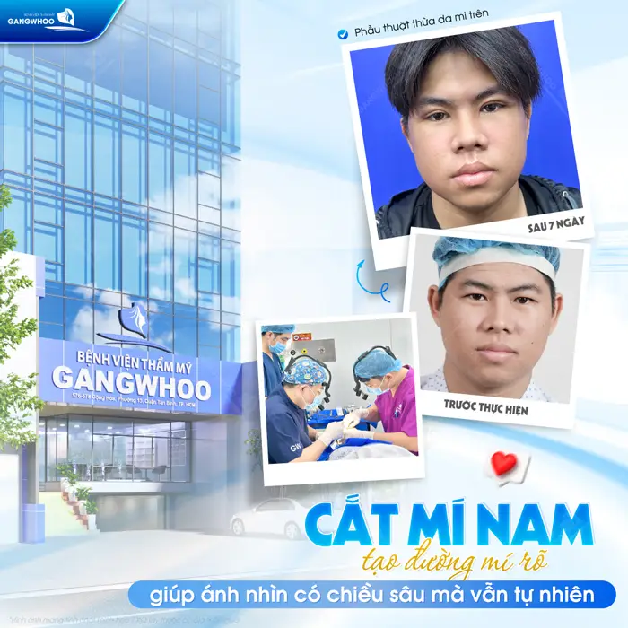 Cắt mí nam tạo đường mí rõ nét sau 7 ngày đã ổn định và vào form mềm mại đến bất ngờ