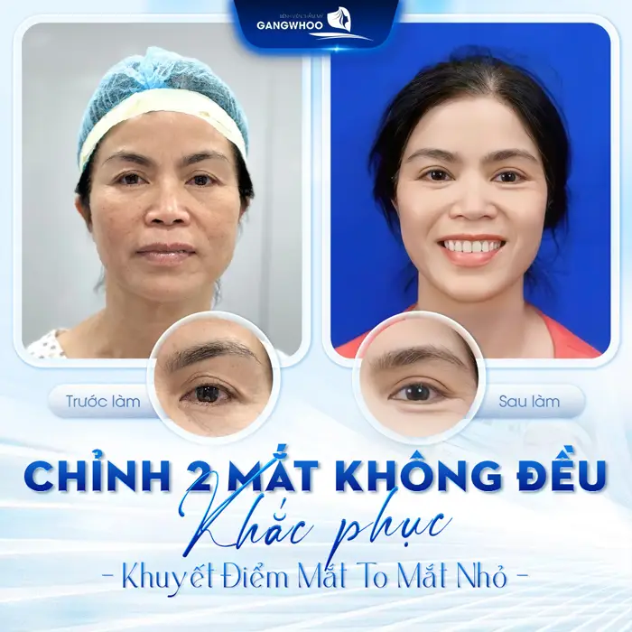 Chỉnh 2 Mắt Không Đều Khắc Phục Khuyết Điểm Mắt To Mắt Nhỏ 2 Chỉnh 2 Mắt Không Đều Khắc Phục Khuyết Điểm Mắt To Mắt Nhỏ