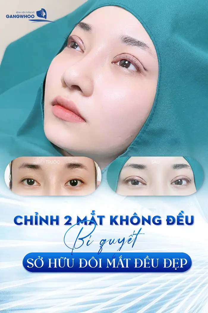 Chỉnh 2 Mắt Không Đều Khắc Phục Khuyết Điểm Mắt To Mắt Nhỏ 5 Chỉnh 2 Mắt Không Đều Khắc Phục Khuyết Điểm Mắt To Mắt Nhỏ