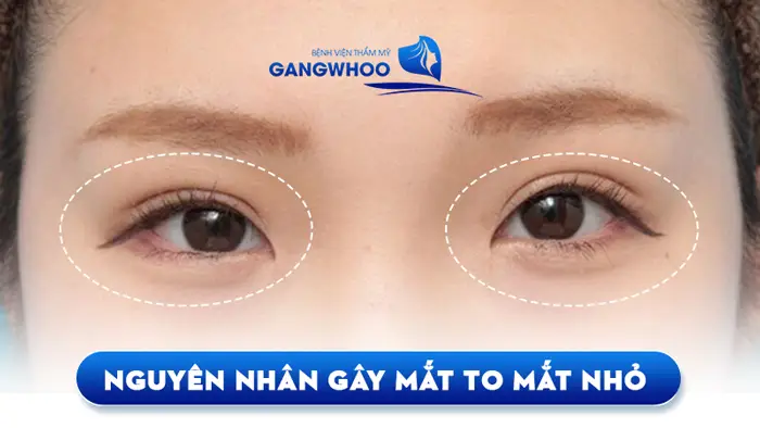 Chỉnh 2 Mắt Không Đều Khắc Phục Khuyết Điểm Mắt To Mắt Nhỏ 1 Chỉnh 2 Mắt Không Đều Khắc Phục Khuyết Điểm Mắt To Mắt Nhỏ