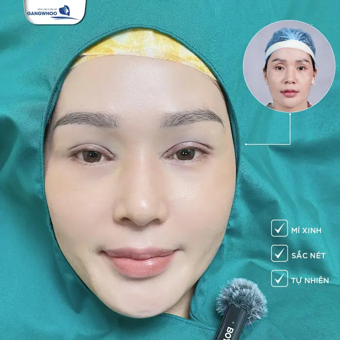 Chỉnh 2 Mắt Không Đều Khắc Phục Khuyết Điểm Mắt To Mắt Nhỏ 3 Chỉnh 2 Mắt Không Đều Khắc Phục Khuyết Điểm Mắt To Mắt Nhỏ