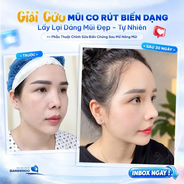 Giải cứu mũi co rút biến dạng lấy lại dáng mũi đẹp, tự nhiên sau can thiệp chỉnh sửa 