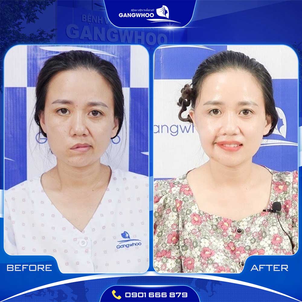 Hình Ảnh Khách Hàng Trị Liệt Mặt Trước & Sau 7 liet mat 2