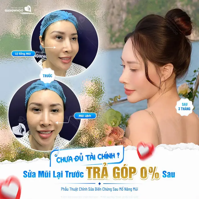 Sửa mũi lại trả trước 0% lãi suất tự tin có mũi đẹp mà không phải lo áp lực tài chính