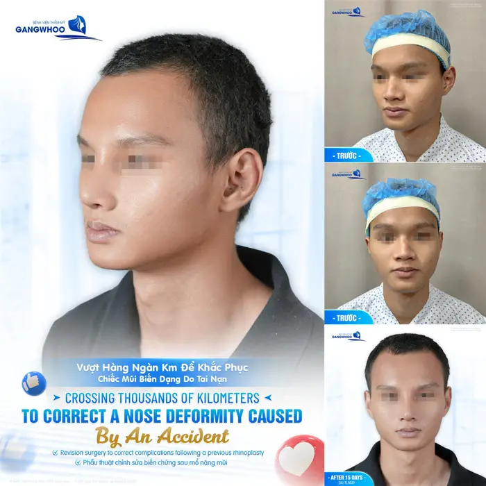 Vượt ngàn km để khắc phục chiéc mũi biến dạng do tai nạn chàng trai hài lòng về nhan sắc của chính mình
