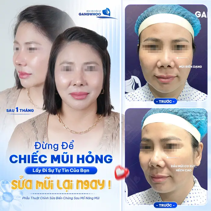 Đừng để mũi hỏng lấy đi sự tự tin của bạn sửa mũi ngay hôm nay để nhan sắc và diện mạo thêm hài hòa và đẹp chuẩn 