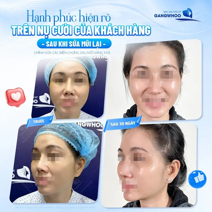 Hạnh phúc hiện rõ trên nụ cười của khách hàng sau khi sửa mũi lại giờ gương mặt và thần thái đã tự tin hơn