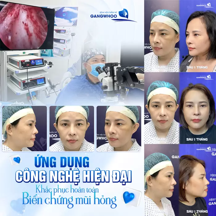 Kết quả nâng mũi sau 6 tháng gương mặt cao đẹp thanh thoát thần thái đẹp khác biệt