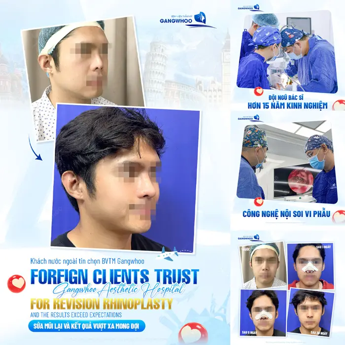 Khách nước ngoài tin chọn Gangwwhoo sửa mũi lại và kết quả vượt trên cả mong đợi