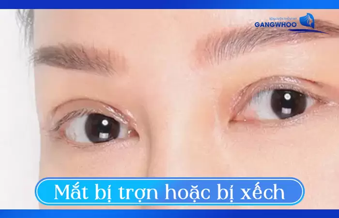 Mắt bị trợn hoặc bị xếch cũng có thể xảy ra nếu như không chú trọng trong việc chăm sóc mí mắt