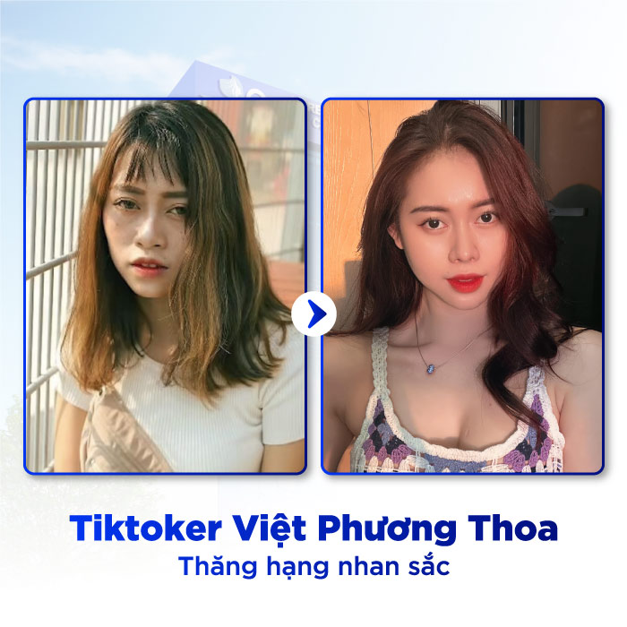 Nâng Mũi Phong Thủy Có Thay Đổi Tướng Số Không? 6 nang mui phong thuy3 1