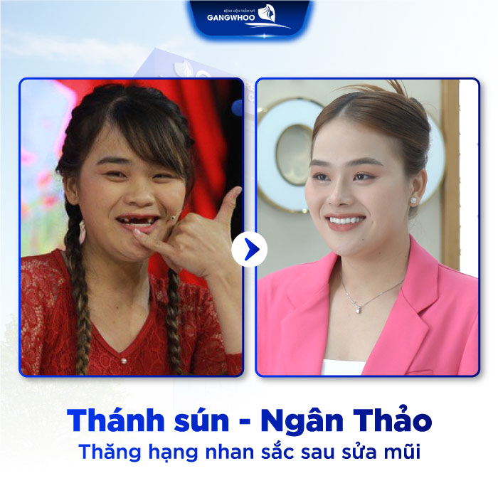 Nâng Mũi Phong Thủy Có Thay Đổi Tướng Số Không? 3 nang mui phong thuy4 1