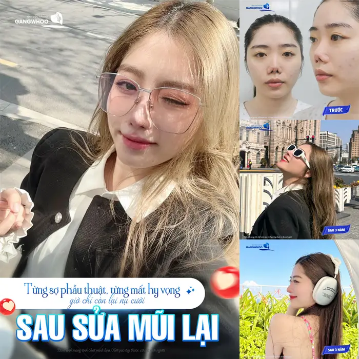 Sửa mũi lại tại bệnh viện thẩm mỹ Gangwhoo từ tự ti đến tự tin đẹp đầy tự tin và cuốn hút