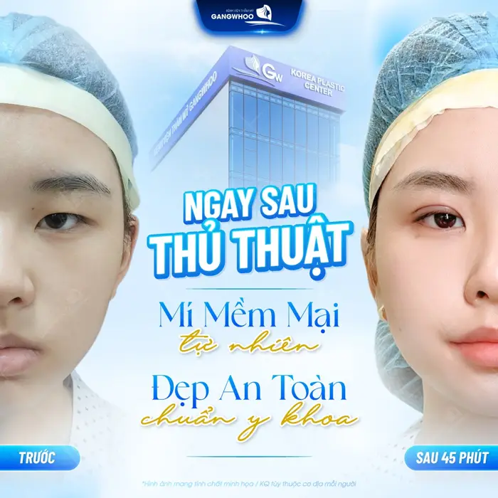 Ngay sau thủ thuật nếp mí đẹp mềm mại, tự nhiên và chuẩn y khoa 