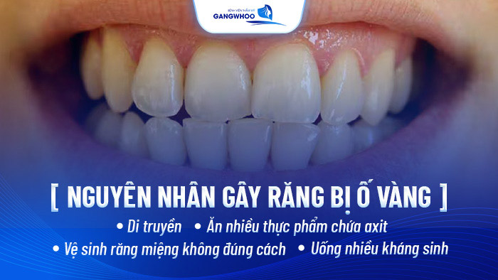 Cách Làm Trắng Răng 