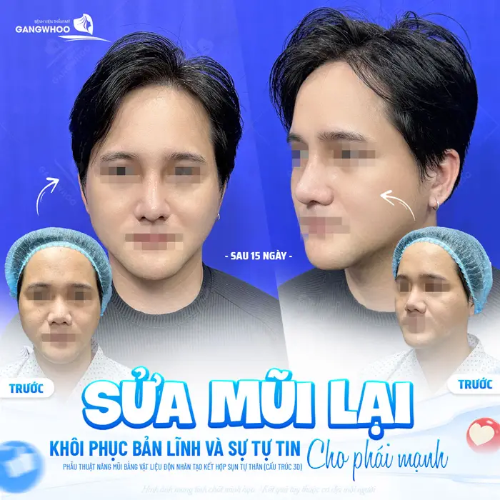 Sửa mũi lại khôi phục bản lĩnh và sự tự tin cho phái mạnh