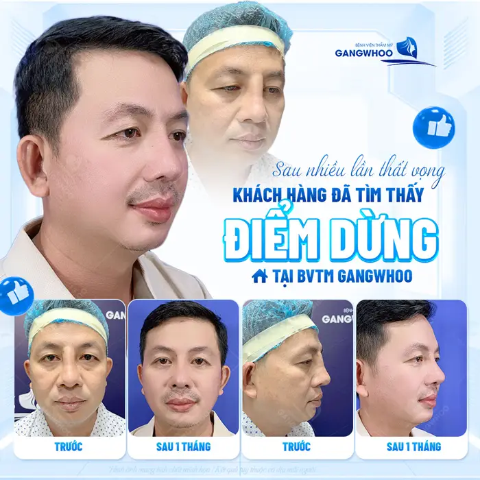 Sau nhiều lần sửa mũi hỏng, khách hàng đã tìm lại hy vọng tại BVTM Gangwhoo