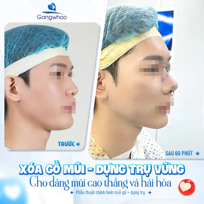 Sửa Mũi Hỏng Gồ Có Đau Không? Cách Điều Trị Mũi Gồ Hiệu Quả