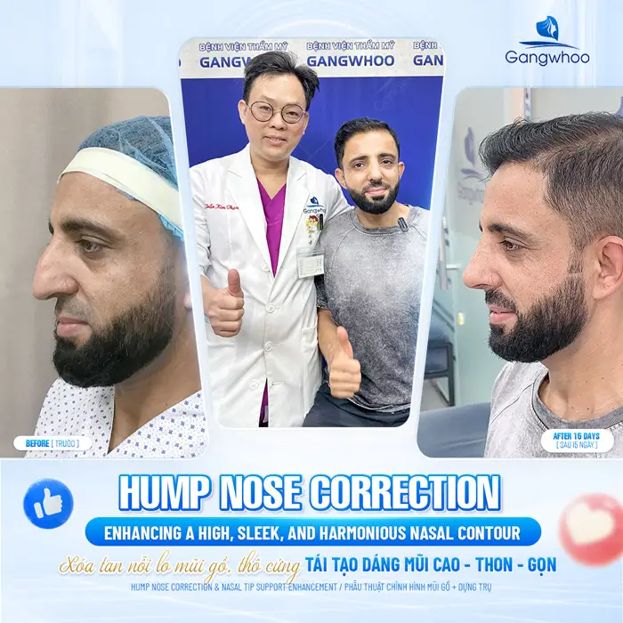 Sửa Mũi Hỏng Gồ Có Đau Không? Cách Điều Trị Mũi Gồ Hiệu Quả