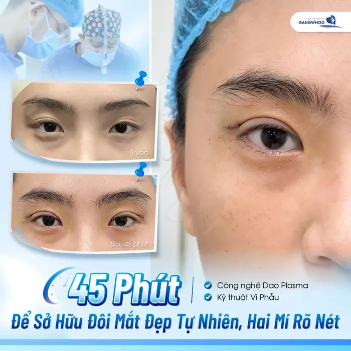 45 phút cắt mí sở hữu diện mạo đều đẹp, hài hòa và rõ nét