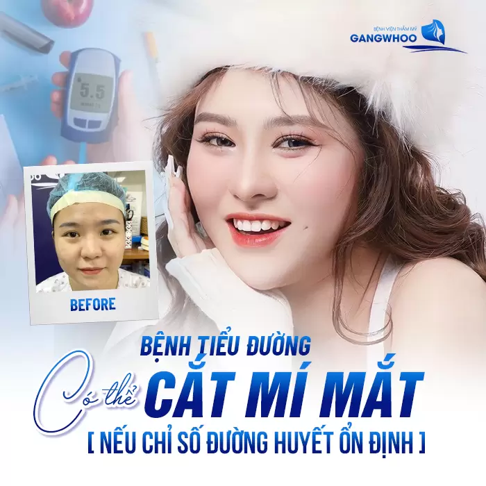 benh tieu duong co the cat mi mat