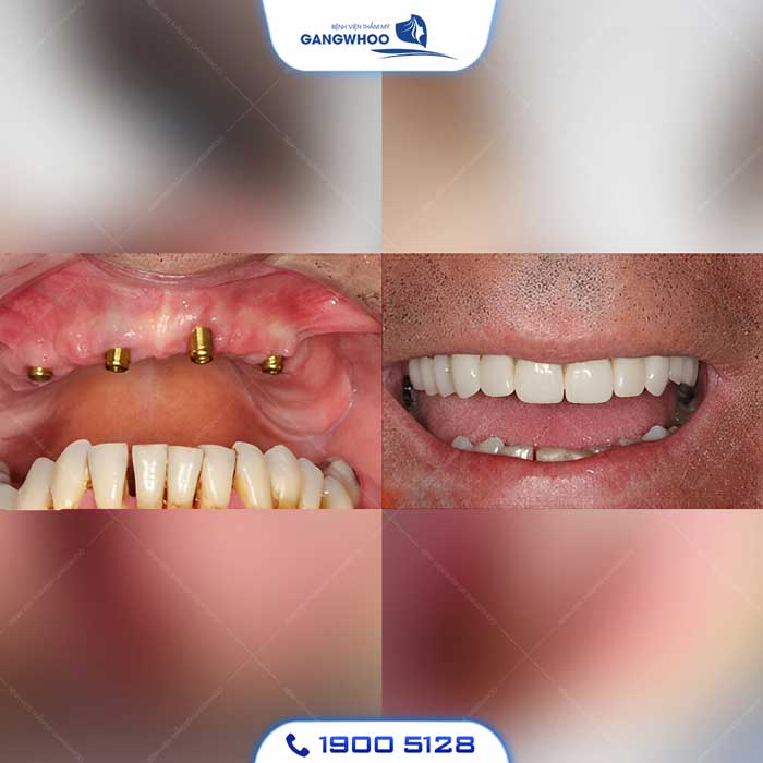 cay ghep implant 15