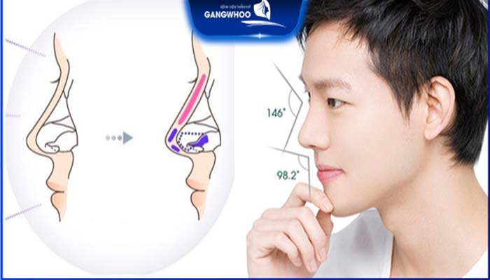 Nên lựa chọn sụn tự thân hay sụn nhân tạo khi nâng mũi