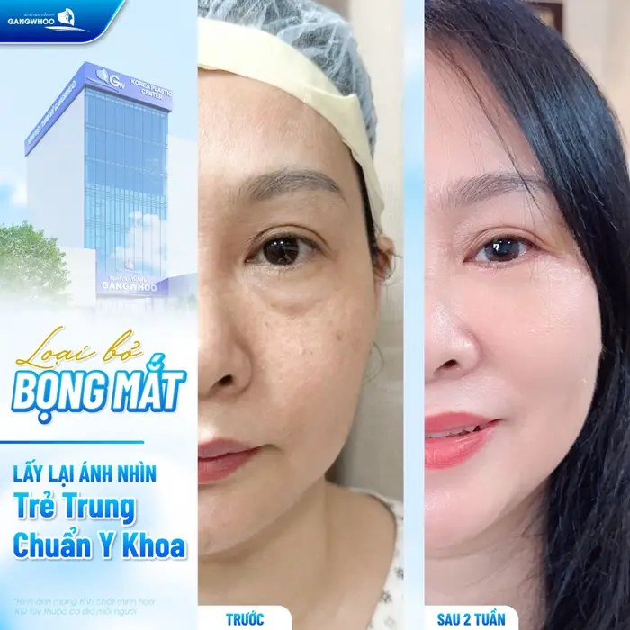 Loại bỏ bọng mắt lấy lại ánh nhìn trẻ trung chuẩn y khoa