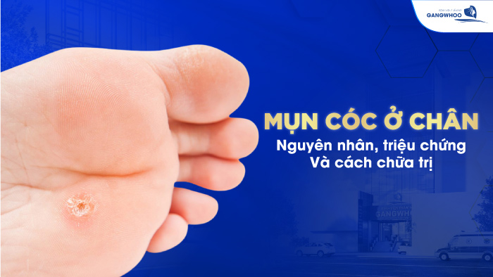Mụn cóc ở chân