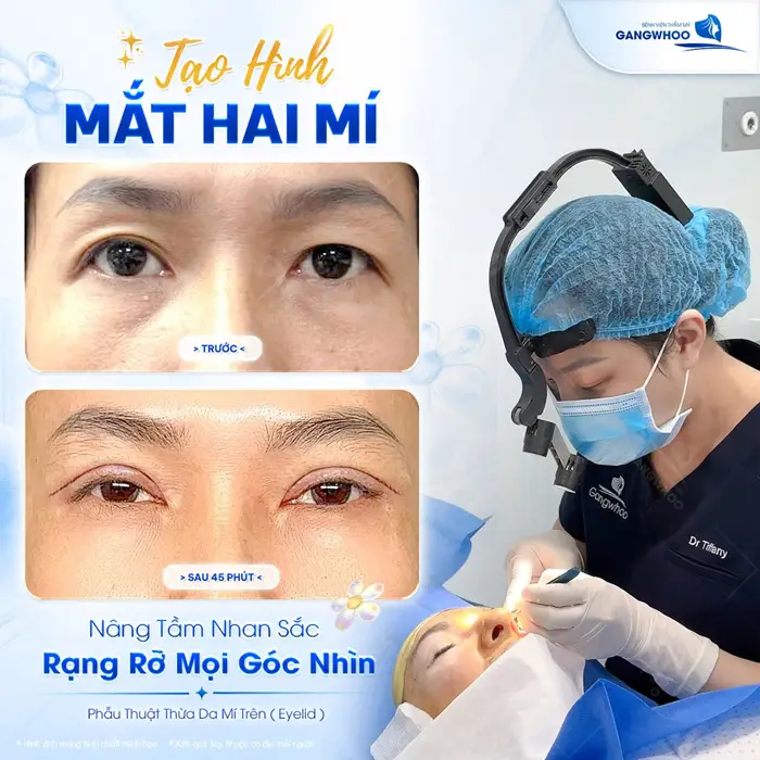 Tạo hình mắt 2 mí nâng tầm nhan sắc rạng rỡ mọi góc nhìn với diện mạo thêm hài hòa và cân đối hơn 