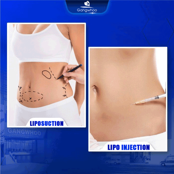Liposuction or Lipotropic Injection