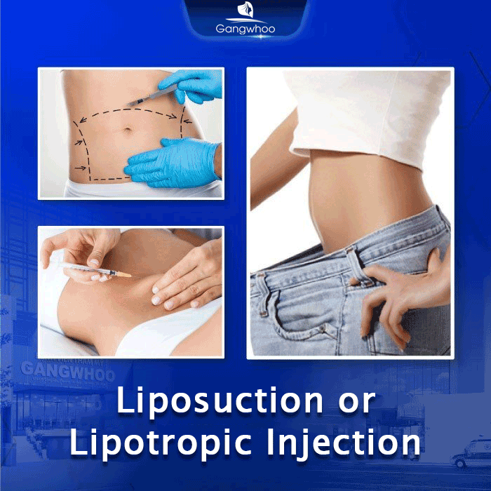 Liposuction or Lipotropic Injection