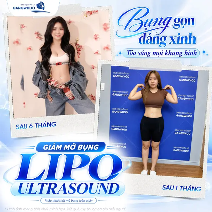 Giảm mỡ bụng công nghệ Lipo Ultrasound kết quả sau 6 tháng dáng bụng thon gọn, cuốn hút và đầy xuất sắc