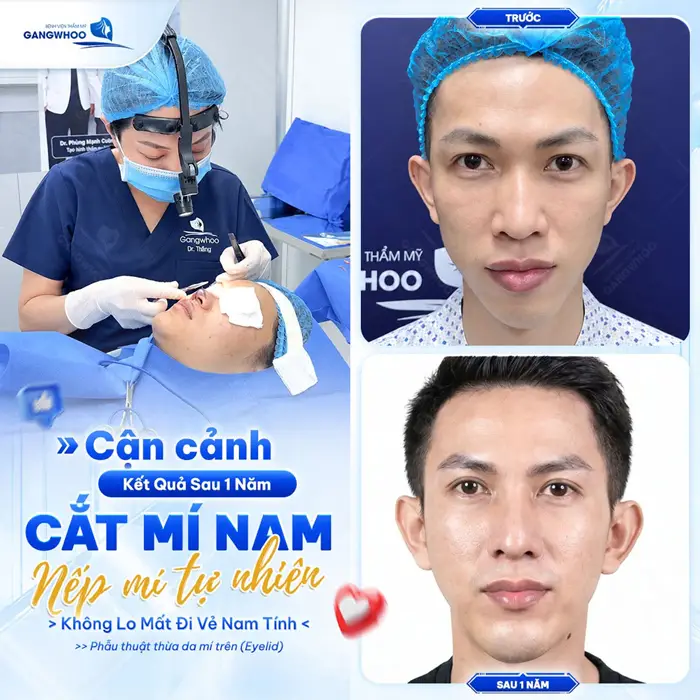 Cận cảnh kết quả sau 1 năm thực hiện cắt mí nam nếp mí đẹp tự nhiên, hài hòa 