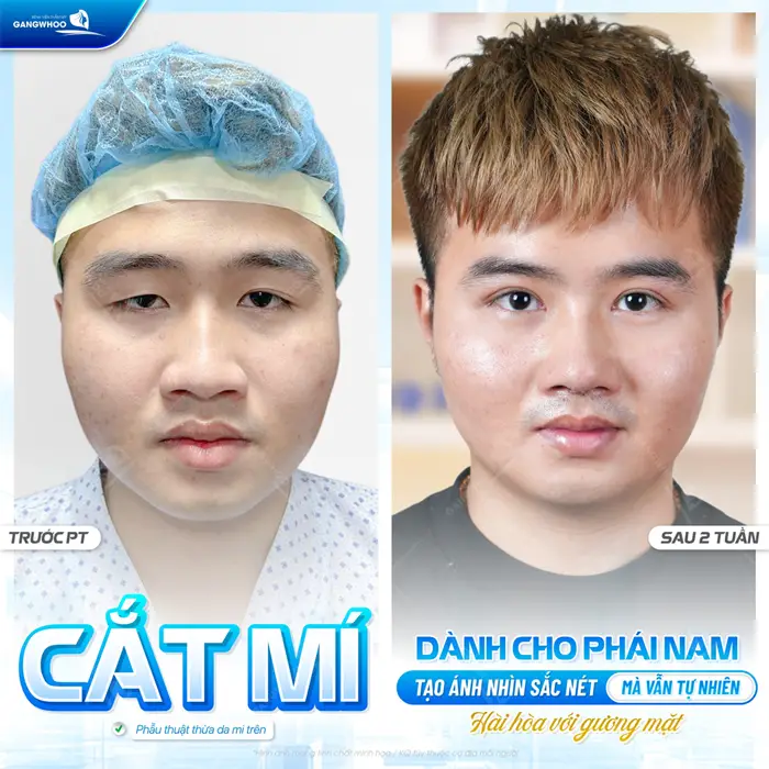 Cắt mí dành cho nam giới tạo ánh nhìn sắc nét mà vẫn tự nhiên hài hòa hơn với gương mặt