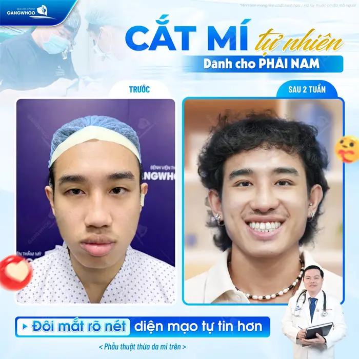 Cắt Mí Cho Nam Giới Có Gì Khác So Với Nữ Giới? 3 Cắt mí tự nhiên dành cho phái nam sau 2 tuần đôi mắt đã đẹp rõ nét và tràn đầy tự tin