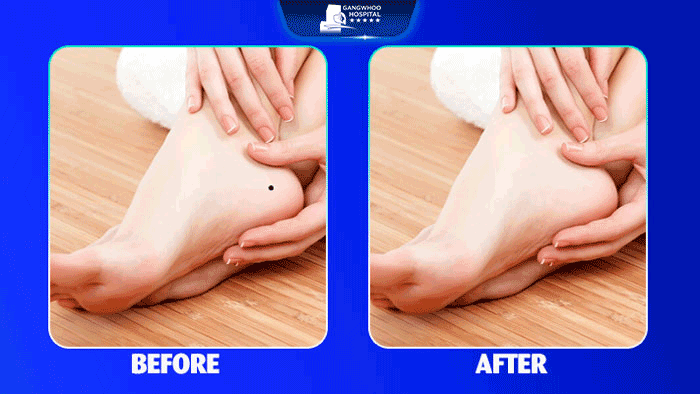 Discover the significance of people having moles on the soles of their feet