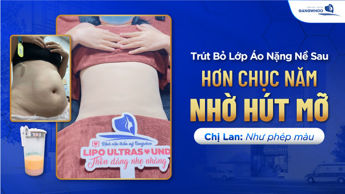 Hút mỡ như phép màu cho chị Lan