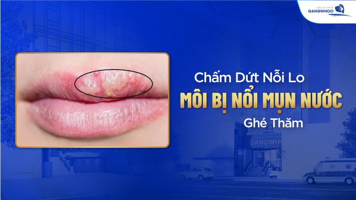 Môi bị mụn nước