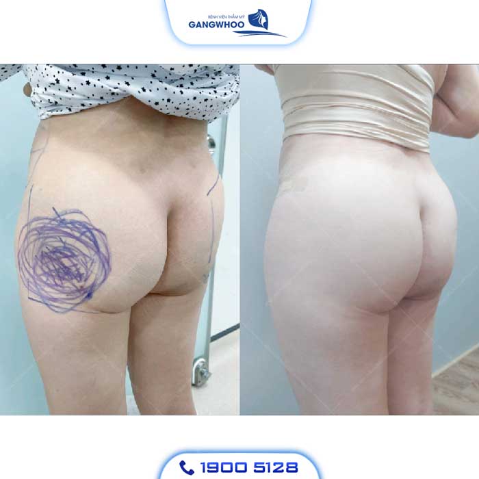 khách hàng thực hiện nâng mông bằng mỡ tự thân