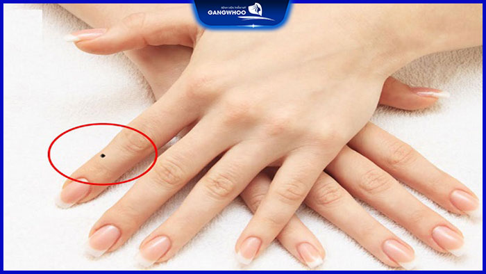Nốt Ruồi Ở Ngón Tay - Liệu Có Phải Là Một Dấu Hiệu Đặc Biệt? 11 Nốt ruồi ở ngón tay