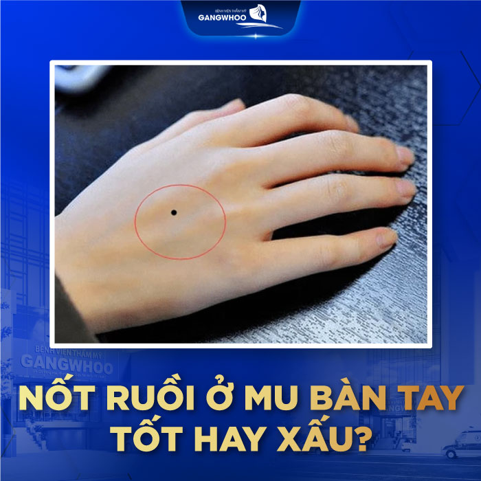 Nốt Ruồi Trên Mu Bàn Tay - Thể Hiện Ý Nghĩa Gì Cho Nam Và Nữ? 8 Nốt ruồi trên mu bàn tay