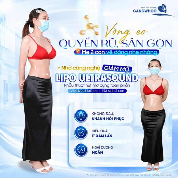 Vòng eo quyến rũ, săn gọn của mẹ 2 con về dáng nhẹ nhàng sau hút mỡ công nghệ Lipo Ultrasound