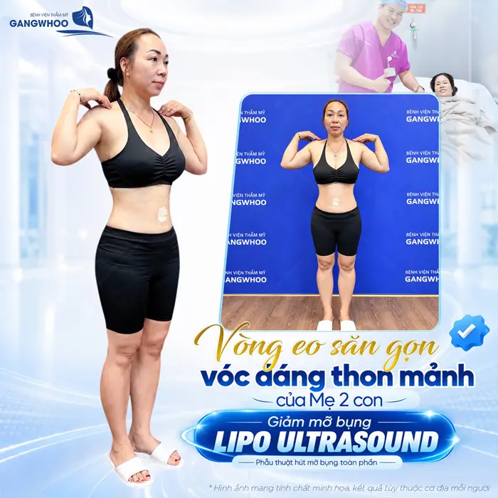 Hút Mỡ Và Tiêm Tinh Chất: Lợi Và Hại 1 Vòng eo săn gọn vóc dáng thon mảnh của mẹ 2 con sau giảm mỡ thành công