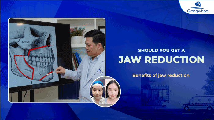 Jaw reduction - should you get it?