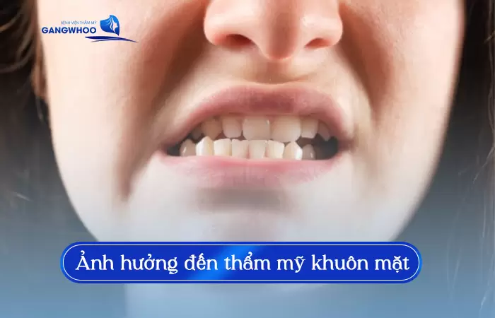 Gọt Hàm Bị Lệch: Nguyên Nhân Và Công Nghệ Cách Khắc Phục