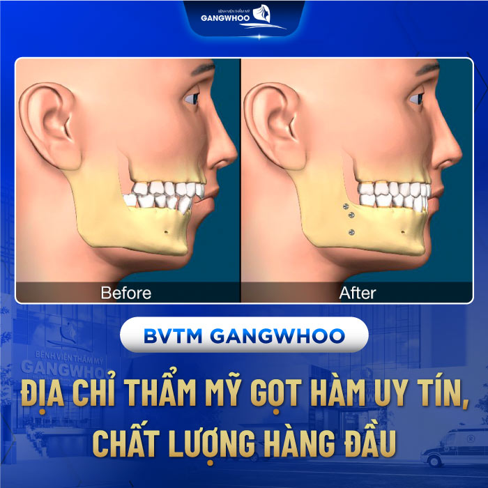 Gọt xương hàm hô