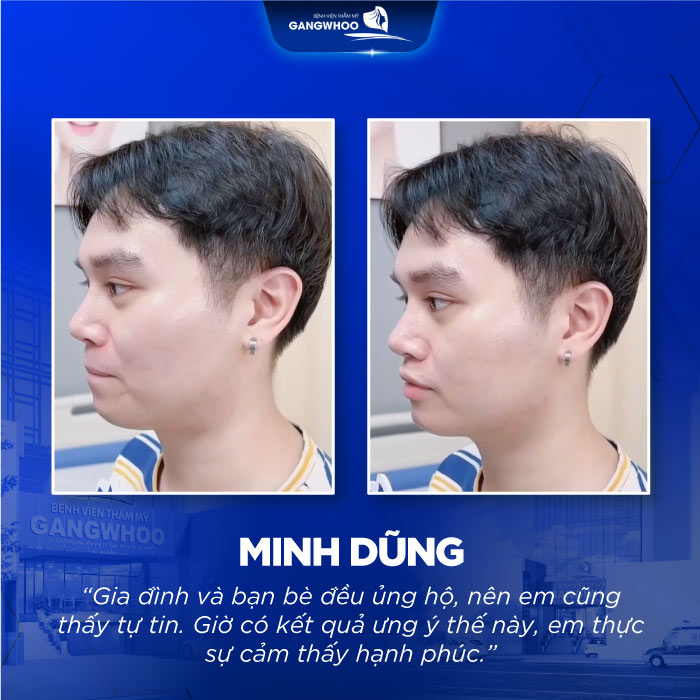 Nâng Cấp Toàn Diện Vẻ Ngoài Cho Bạn Minh Dũng Sau 60 Phút Nâng Mũi Nano Form 6 Nâng Cấp Toàn Diện Vẻ Ngoài Cho Bạn Minh Dũng Sau 60 Phút Nâng Mũi Nano Form