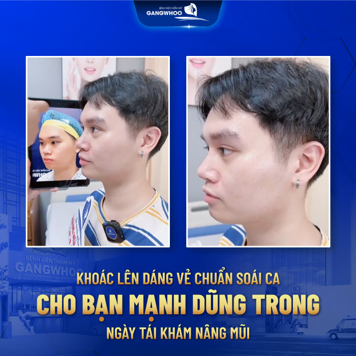Nâng Cấp Toàn Diện Vẻ Ngoài Cho Bạn Minh Dũng Sau 60 Phút Nâng Mũi Nano Form 7 Nâng Cấp Toàn Diện Vẻ Ngoài Cho Bạn Minh Dũng Sau 60 Phút Nâng Mũi Nano Form
