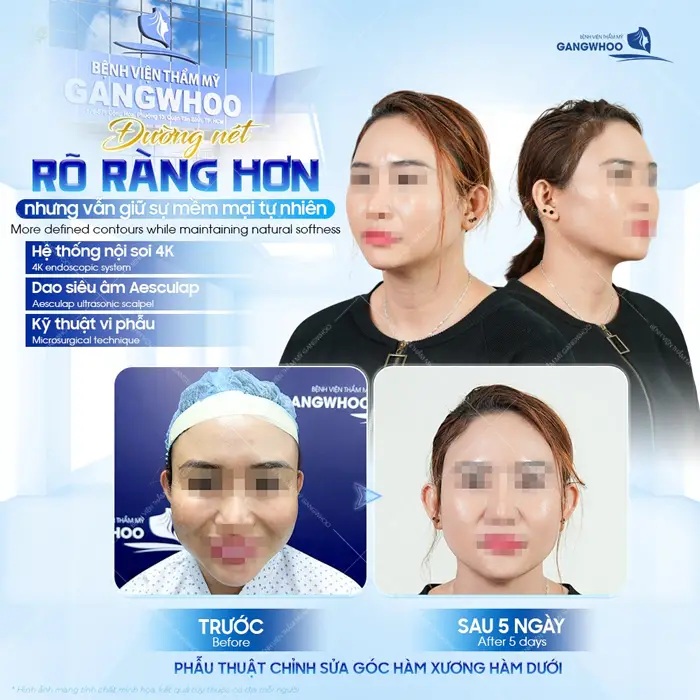 Đường nét rõ ràng hơn nhưng vẫn giữ được sự mềm mại, tự nhiên sau 5 ngày đã vô form đẹp thấy rõ